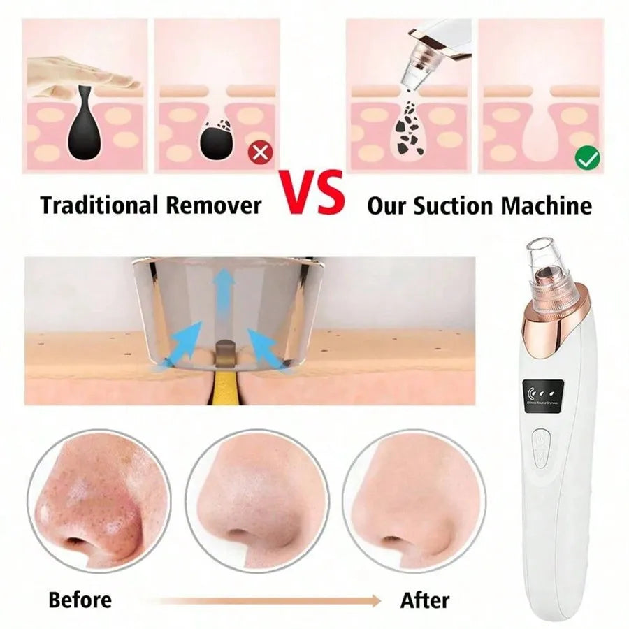 Electric Pore Vacuum &amp; Blackhead Remover – Deep Facial Cleansing Device by Mallinaz